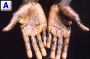 Name that rash...monkeypox on hands