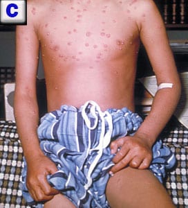 Name that rash...varicella (chickenpox) on child