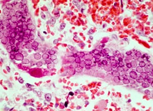 Microscope image of Measles virus