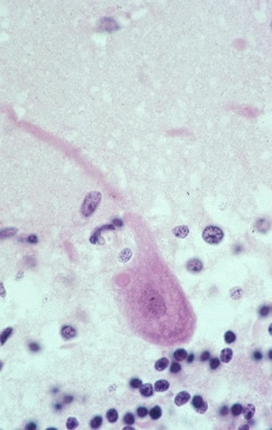 Photomicrograph of a hematoxylin and eosin stain of brain tissue from a patient infected with rabies virus.