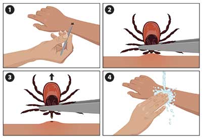 Clipart image of someone removing a tick from their arm with tweezers.