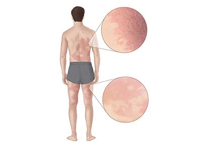 Illustration of a man with Alpha-gal Syndrome rash on his back and legs