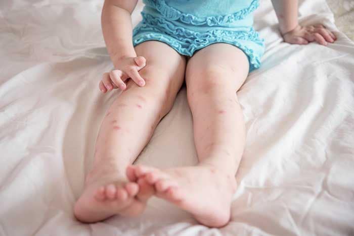 A child with multiple mosquito bites on her legs