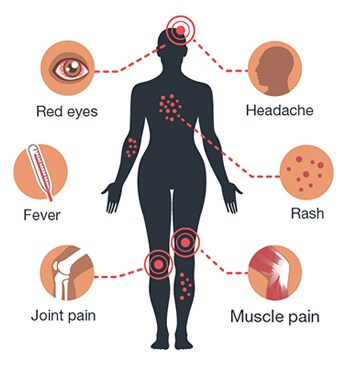 Symptoms of Zika:  joint pain, fever, red eyes, headache, rash, muscle pain