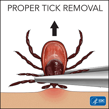 Proper Tick Removal - To remove a tick, grasp it with tweezers, as close to the skin as possible, and pull it straight out.
