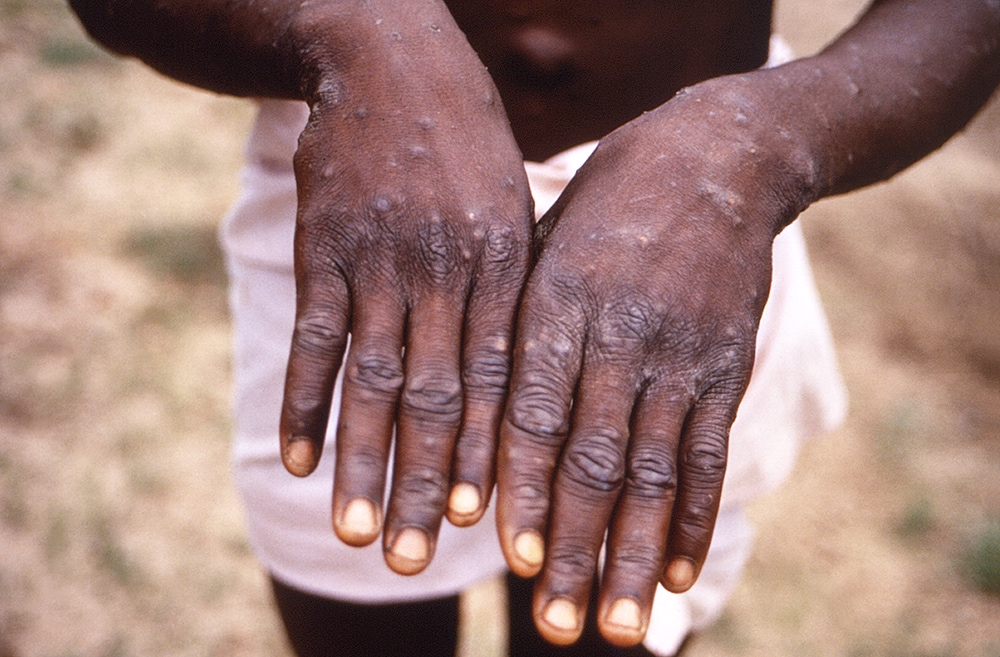 Monnkeypox in the DRC