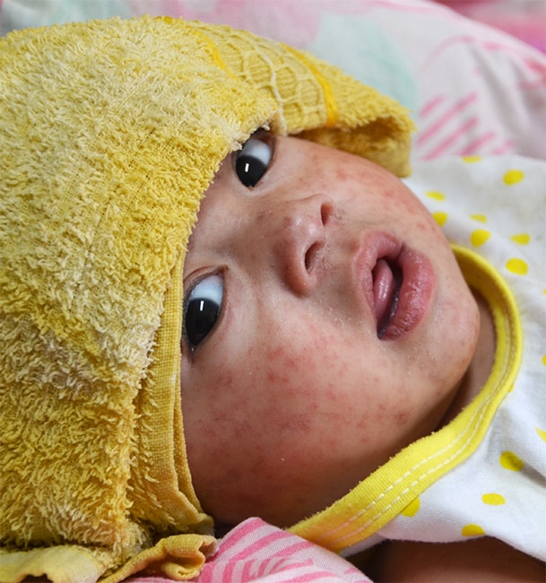 A baby with measles