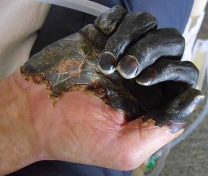 Skin on a man’s hand pictured here to turned black and die due to a plague