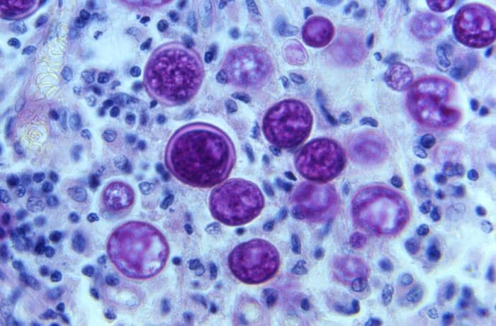 Under a magnification of 500X, this photomicrograph of a periodic acid–Schiff (PAS)-stained lymph node tissue sample, revealed the presence of a number of Coccidioides immitis (the fungus that causes Valley fever) spherules in various stages of development.
