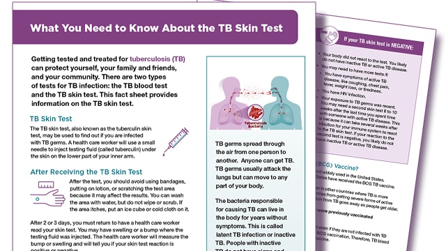TB Skin Test Infographic