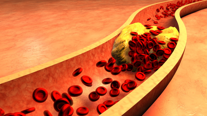 Image of clogged artery.