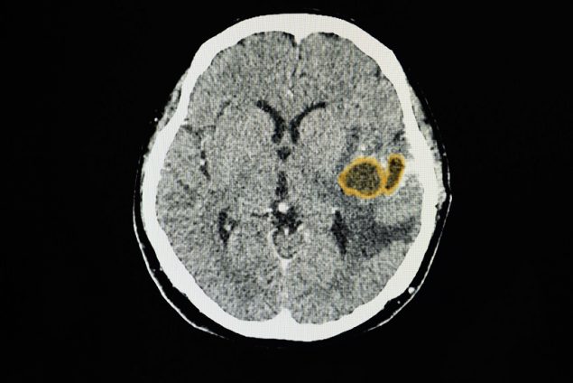 CT scan of a patient with a large brain abscess