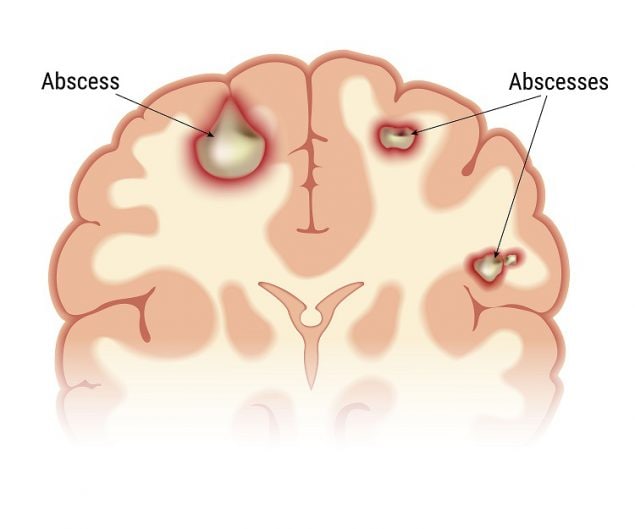 Illustration of brain abscesses