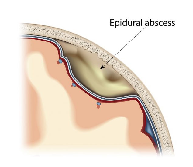 Illustration of an epidural abscess