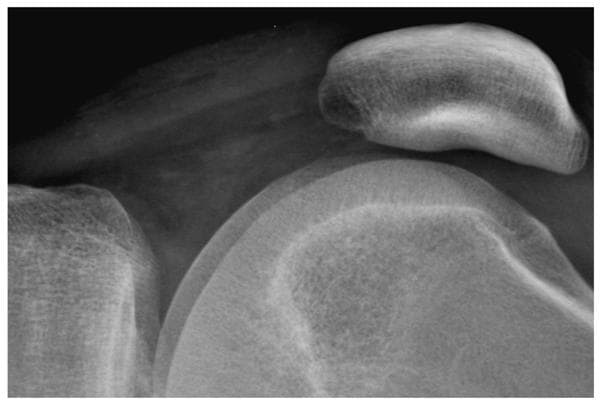 Figure 3a. A digital radiograph of the knee taken with a high resolution CR screen (HR screen, Eastman Kodak Company) is illustrated using display processing with no edge restoration.