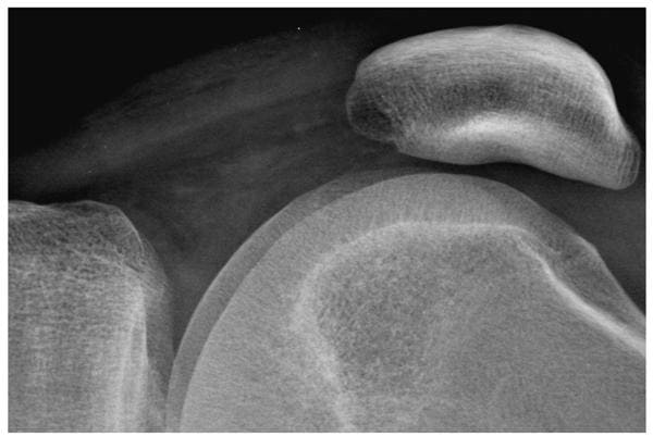 Figure 3b. The knee radiograph shown in figure 3a is illustrated using display processing with edge restoration.