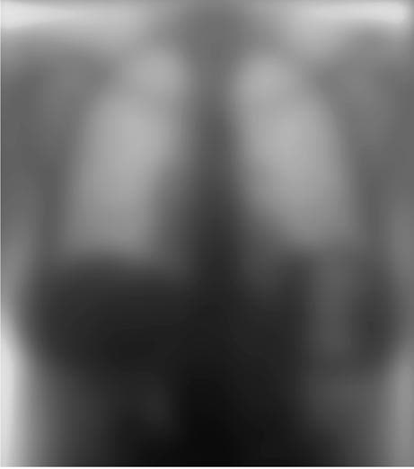 Figure 4b. An unsharp mask image derived from the chest image in figure 4a is illustrated with the grayscale reversed.