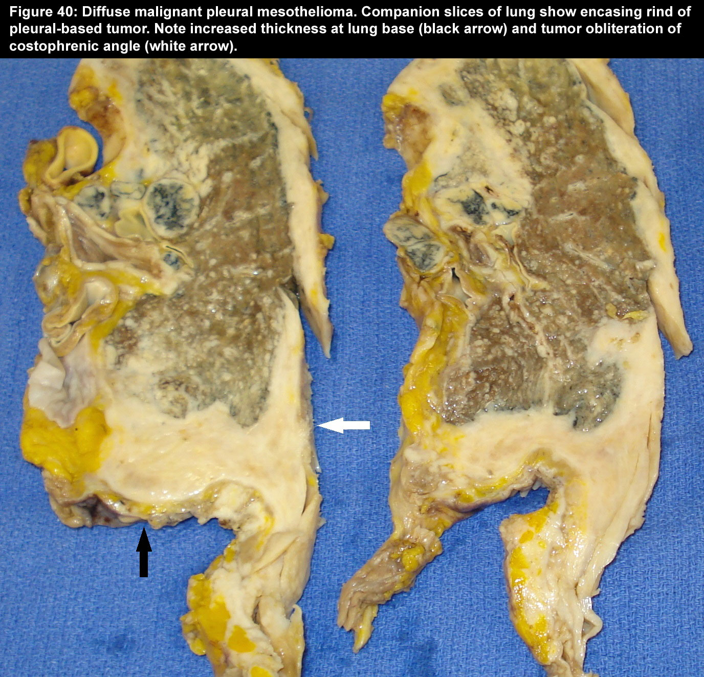 bowel cancer spread to peritoneum prognosis