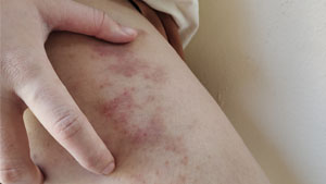 About Skin Exposures and Effects | Skin Exposures and Effects | CDC