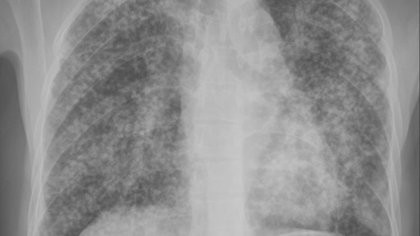 An x-ray of a lung with disease.