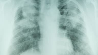 Lung x-ray showing pneumoconiosis in coal miner.