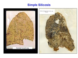 Example slide: normal lung versus lung with simple silicosis