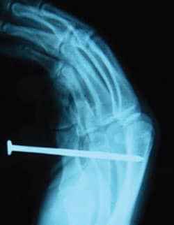 X-ray of nailgun injury
