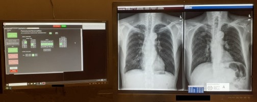monitors dispaying the bviewer software and chest x-rays