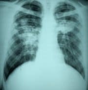 Radiograph showing Progressive Massive Fibrosis