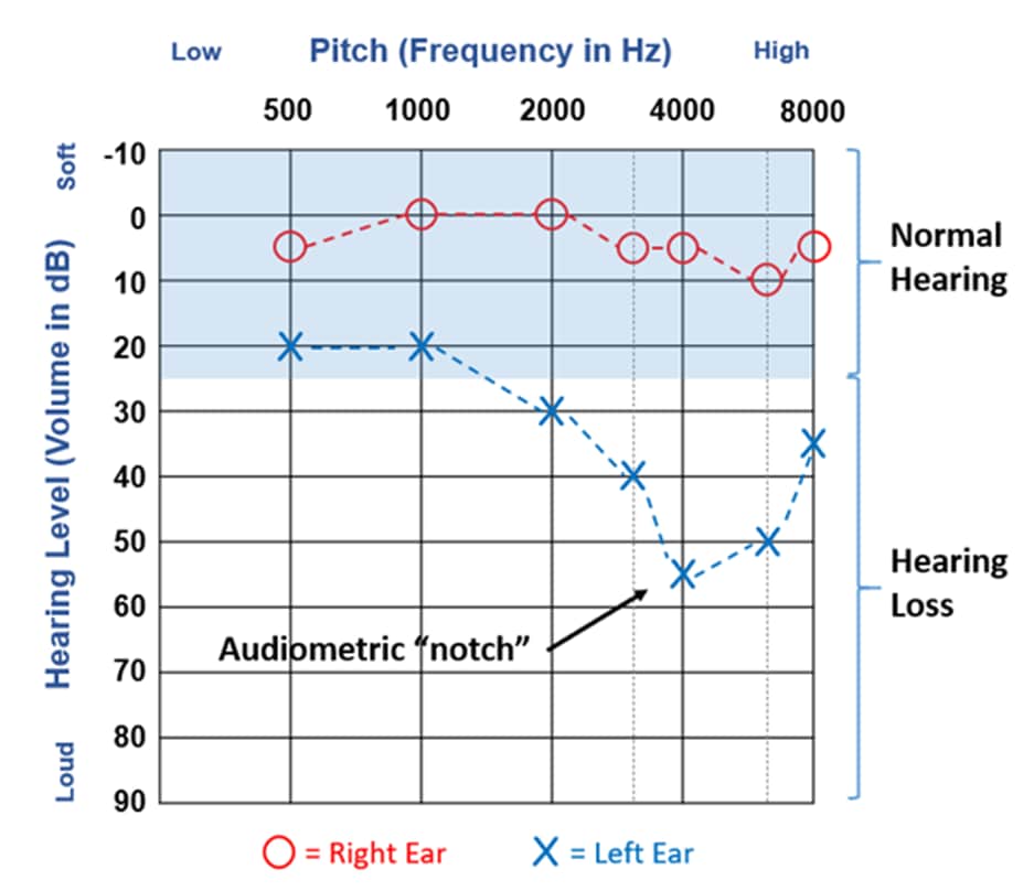 An audiogram shows normal hearing in the right ear, and mild-to-moderate hearing loss in the left ear.