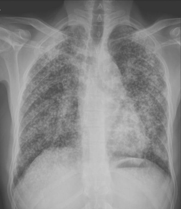 An x-ray of a lung with silicosis and progressive massive fibrosis (PMF).