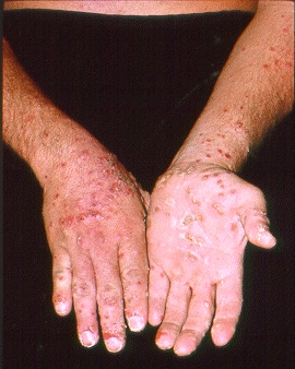 Irritant & Allergic Contact Dermatitis | Cleveland Clinic