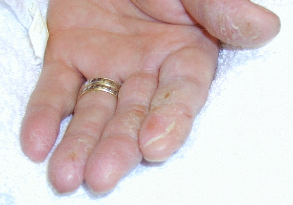 hand dermatoses