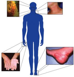 Silhouette of person showing area of skin diseases