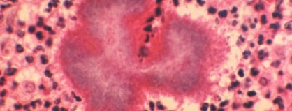 Stained photomicrograph of a tissue sample of a mycetoma excised from a patient's thorax ill with nocardiosis.