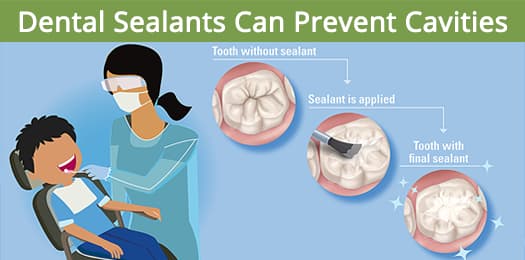 Dental sealants can prevent cavities