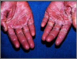 Photo of hands of a patient suffering from toxic shock.