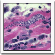 An image of a microscopic view of thin section of heart muscle containing nest of T. cruzi amastigotes.