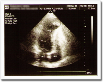 Sonogram of a heart showing a Thrombus formation.