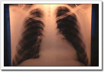 Chest Xray of a patient with advanced Chagas disease. Photo courtesy of WHO/TDR/Crump Argentina, 1999.