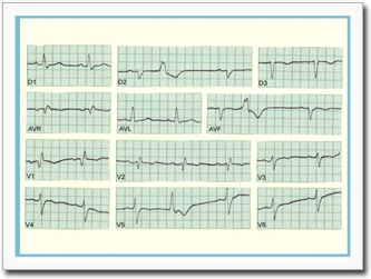 Typical EKG findings in a patient with mild to moderate Chagas cardiomyopathy.