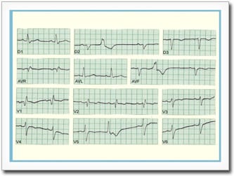 Typical EKG findings in a patient with mild to moderate Chagas cardiomyopathy.