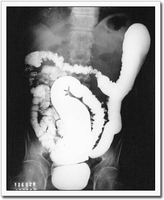 X-Ray image of megacolon in Chagas patient.