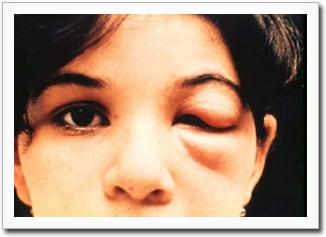 Acute Chagas disease in a young child. The eye sign of Romaña is present. Photo courtesy of WHO/TDR Image Library. TDR photo, Brazil, 1991.