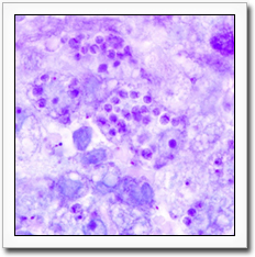 Nests of T. cruzi amastigotes in Giemsa-stained biopsy section from Chagas disease abscess in the brain of an HIV-coinfected patient (original magnification 1000X).