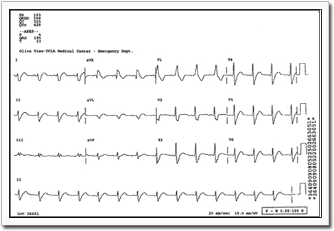 Image of an EKG showing signs of a right bundle branch block.