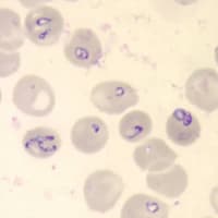 <em>Babesia</em> parasites in red blood cells on a stained blood smear. (CDC Photo: DPDx)