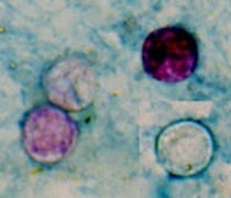 Four <em>Cyclospora</em> oocysts from fresh stool stained using a modified acid-fast stain. The oocysts are variably acid fast (that is, they range from unstained to light pink to deep red or purple). (Credit: CDC/<a href=