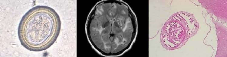 Neurocysticercosis: definíció, tünetek és kezelés