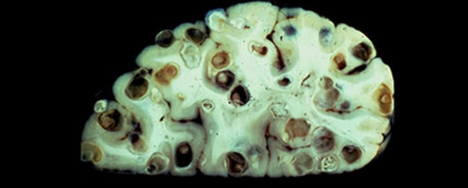 Gross of massive parenchymal cysts